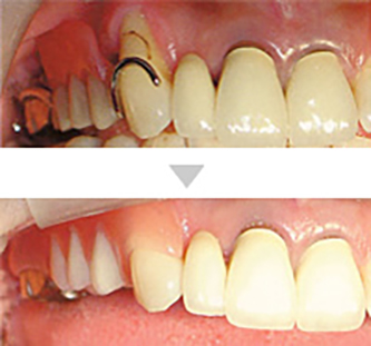 クラウン歯科｜義歯（入れ歯）の種類や特徴紹介